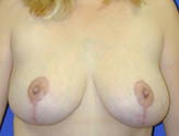 Patient # 21243 After Photo # 2