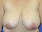 Patient # 21243 Before Photo # 1