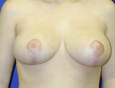 Patient # 12561 After Photo # 2