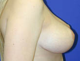 Patient # 12561 After Photo # 4