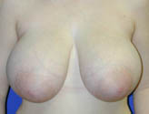 Patient # 12561 Before Photo # 1