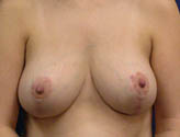 Patient # 27503 After Photo # 2
