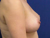 Patient # 27503 After Photo # 4