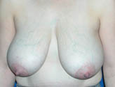 Patient # 27503 Before Photo # 1