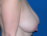 Patient # 27503 Before Photo # 3