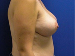 Patient # 51558 After Photo # 4