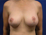Patient # 66424 After Photo # 2