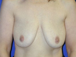 Patient # 66424 Before Photo # 1