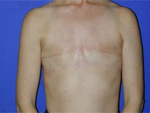 Patient # 81878 Before Photo # 1