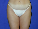 Patient # 12277 After Photo # 2