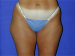Patient # 12277 Before Photo # 1