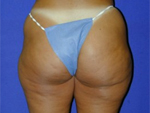 Patient # 12277 Before Photo # 3