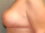 Patient # 96608 After Photo # 4