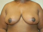 Patient # 24779 After Photo # 2