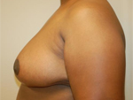 Patient # 24779 After Photo # 4