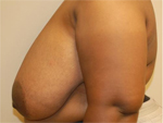 Patient # 24779 Before Photo # 3