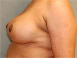 Patient # 35346 After Photo # 4