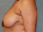 Patient # 35346 Before Photo # 3