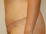 Patient # 43330 After Photo # 4