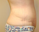 Patient # 83995 After Photo # 4