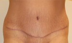 Patient # 21913 After Photo # 2