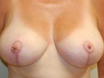 Patient # 46322 After Photo # 2