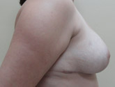 Patient # 88632 After Photo # 4