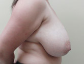 Patient # 88632 Before Photo # 3