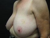 Patient # 76263 Before Photo # 3