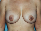 Patient # 10828 After Photo # 2