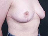 Patient # 50935 After Photo # 2