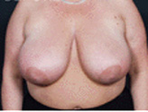 Patient # 31012 Before Photo # 1