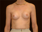 Patient # 57744 Before Photo # 1