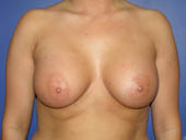 Patient # 36607 After Photo # 2