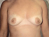 Patient # 17237 Before Photo # 1