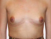 Patient # 17439 Before Photo # 1