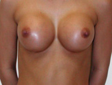 Patient # 61843 After Photo # 2