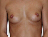 Patient # 61843 Before Photo # 1