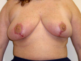Patient # 73356 After Photo # 2