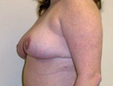 Patient # 73356 After Photo # 4
