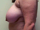 Patient # 73356 Before Photo # 3