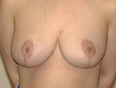 Patient # 73050 After Photo # 4