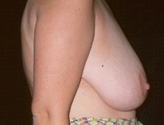 Patient # 73050 Before Photo # 1