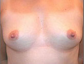 Patient # 45499 Before Photo # 1