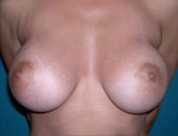 Patient # 44266 After Photo # 2