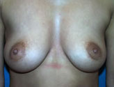 Patient # 44266 Before Photo # 1