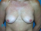 Patient # 68526 Before Photo # 1