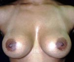 Patient # 53280 After Photo # 2
