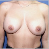 Patient # 80382 After Photo # 2