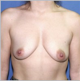Patient # 80382 Before Photo # 1